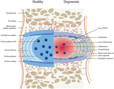 Mesenchymal Stem Cell-Derived Exosomes as a Novel Strategy for the Treatment of Intervertebral Disc Degeneration